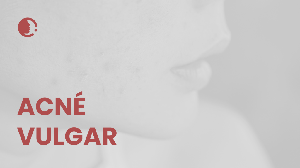 Actualización 2025 en el abordaje del acné vulgar: Terapias tópicas emergentes
sin antibióticos