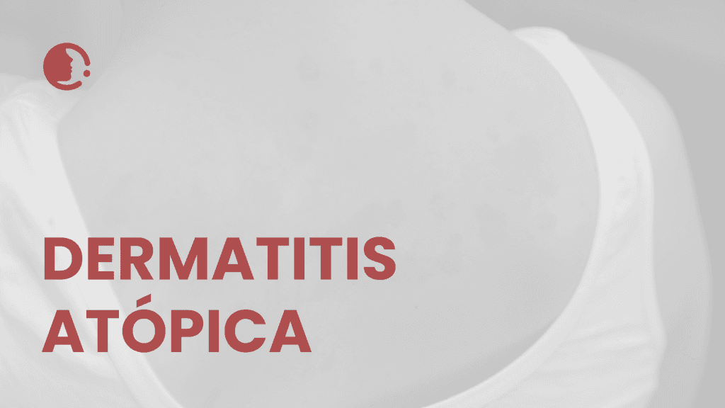 Guía 2025 para el manejo integral de la dermatitis atópica: enfoque clínico
actualizado