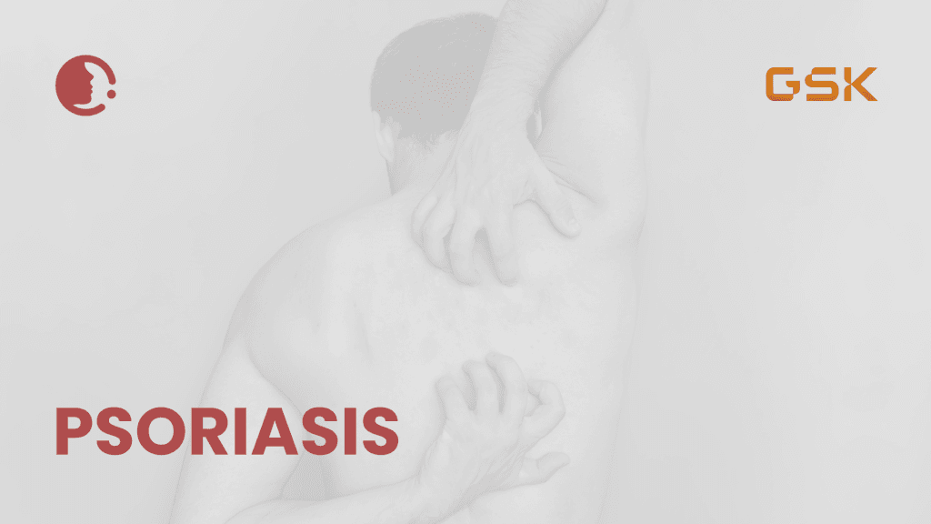 Psoriasis: Más allá de lo superficial – Reevaluando el papel clave de la terapia tópica