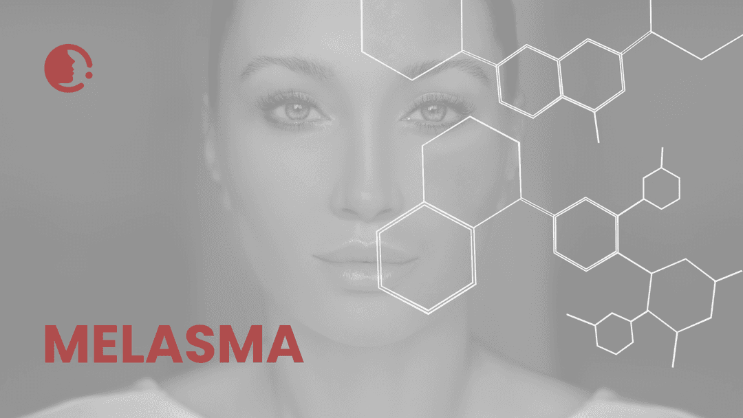 Melasma: ¿peeling de ácido azelaico o microneedling con ácido tranexámico? una
comparativa crucial para nuestra práctica