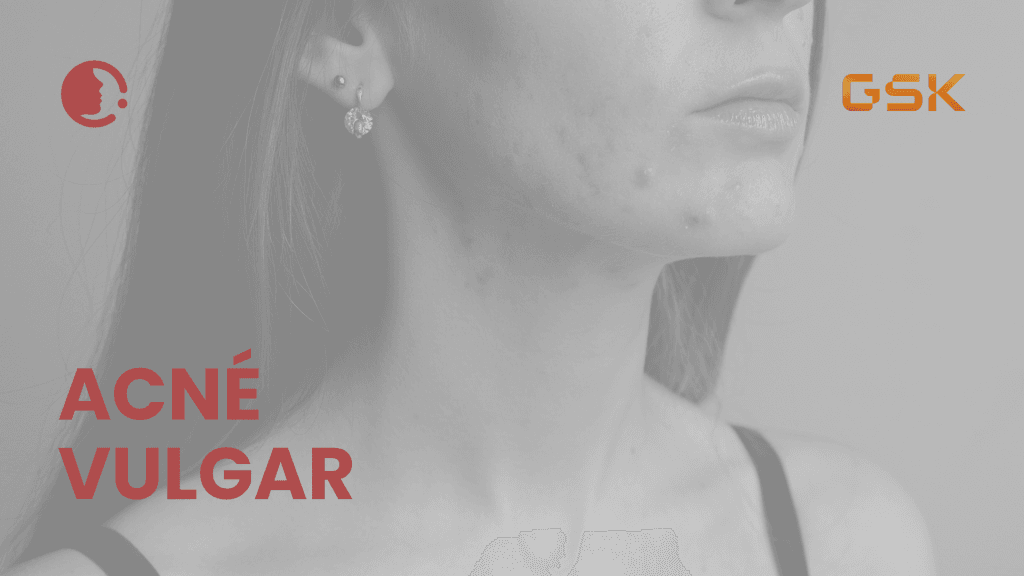 Acné vulgar: un meta-análisis aclara la tolerabilidad en la práctica clínica