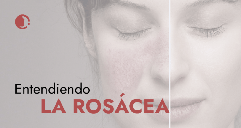 Entendiendo la rosácea: causas, síntomas y diagnóstico
