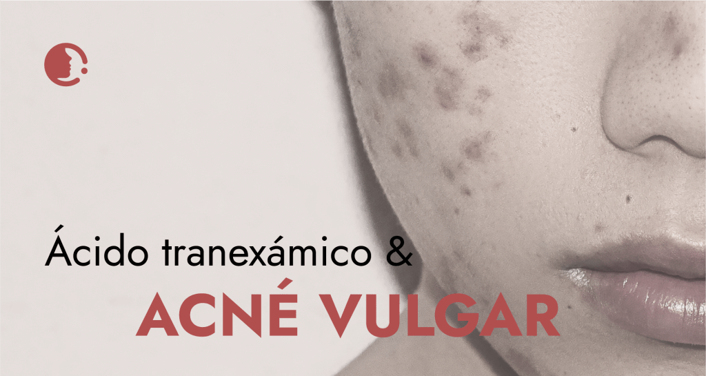 Ácido tranexámico y el acné vulgar