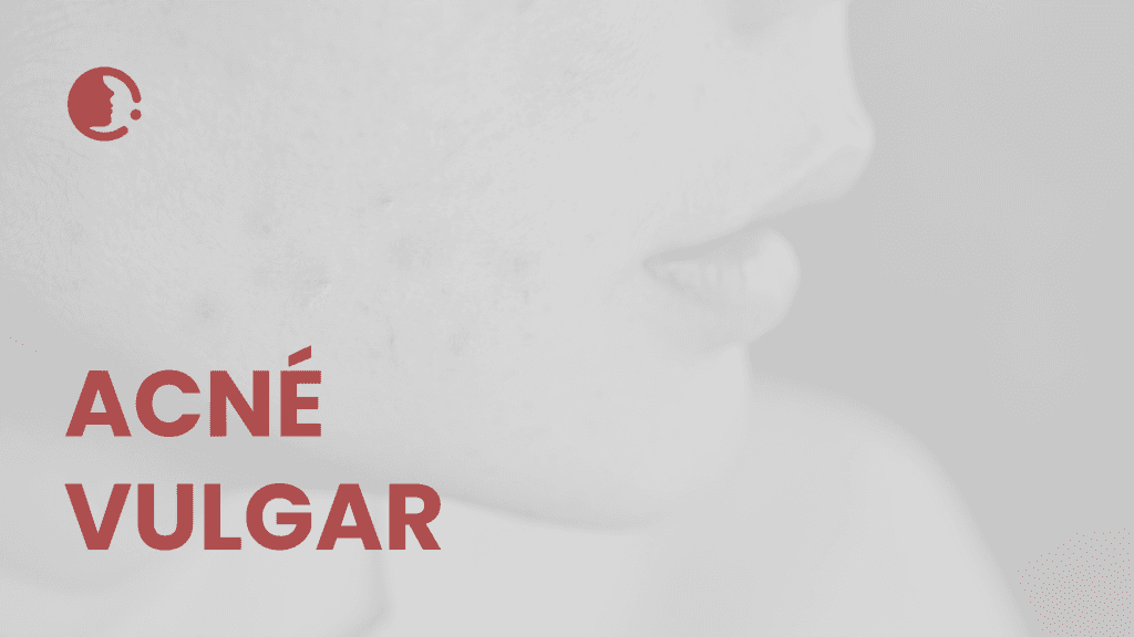 Actualización 2025 en el abordaje del acné vulgar: Terapias tópicas emergentes
sin antibióticos