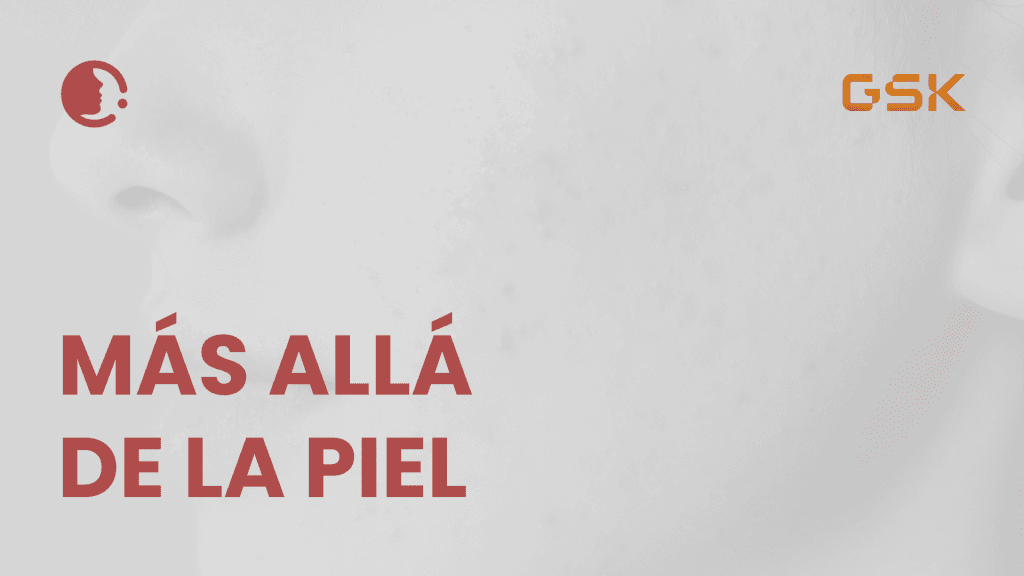 Mucho más allá de la piel : la crucial relevancia del tratamiento del acné hoy