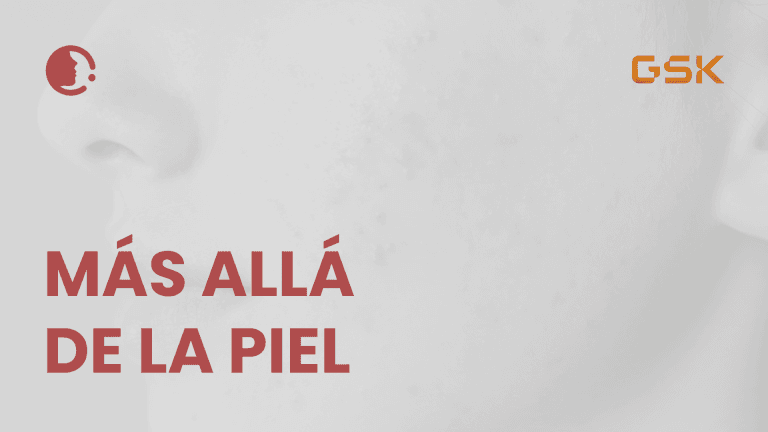 Mucho más allá de la piel : la crucial relevancia del tratamiento del acné hoy