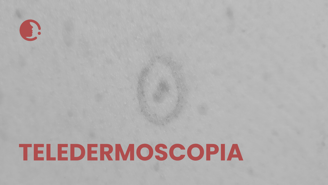 Teledermoscopia: ¿el inicio de una nueva era en la detección del cáncer de piel?