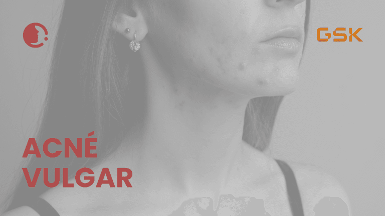 Acné vulgar: un meta-análisis aclara la tolerabilidad en la práctica clínica