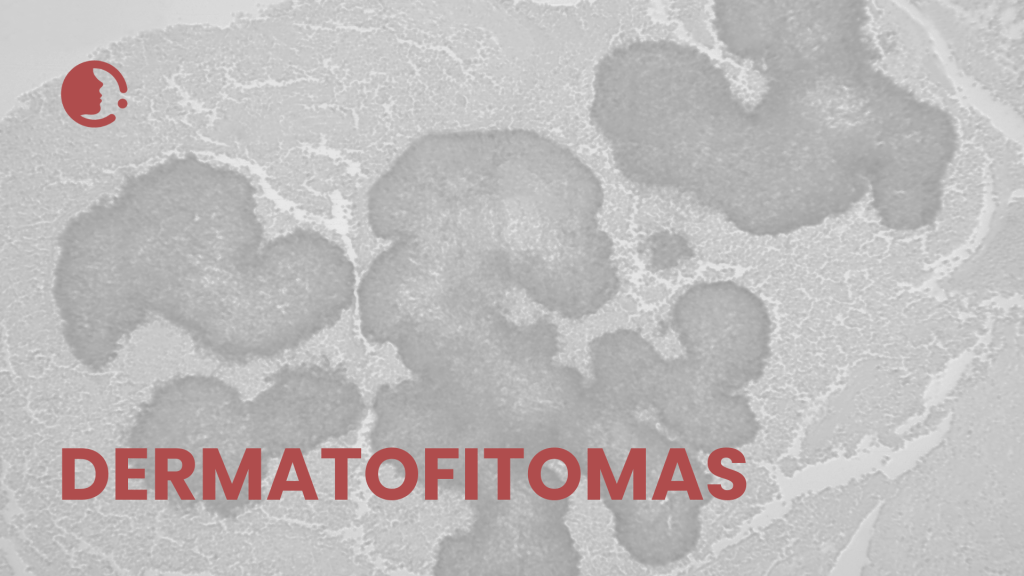 Desentrañando los dermatofitomas y conglomerados fúngicos: implicaciones
epidemiológicas y clínicas en la práctica diaria