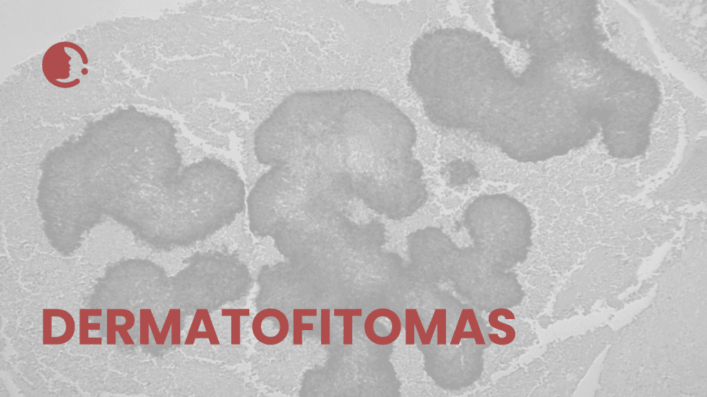 Desentrañando los dermatofitomas y conglomerados fúngicos: implicaciones
epidemiológicas y clínicas en la práctica diaria