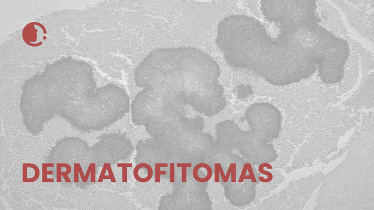 Desentrañando los dermatofitomas y conglomerados fúngicos: implicaciones
epidemiológicas y clínicas en la práctica diaria