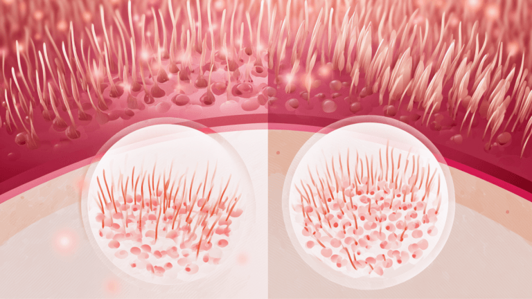 Bicalutamida vs. espironolactona en alopecia androgénica femenina